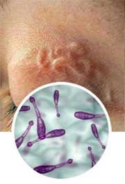Public transport as a route of parasite contamination